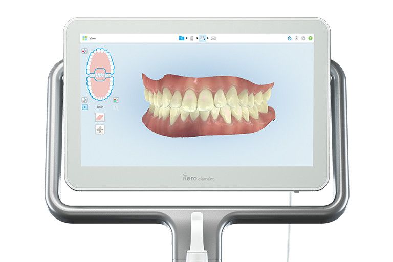 Digital impression scanner used for precise smile planning