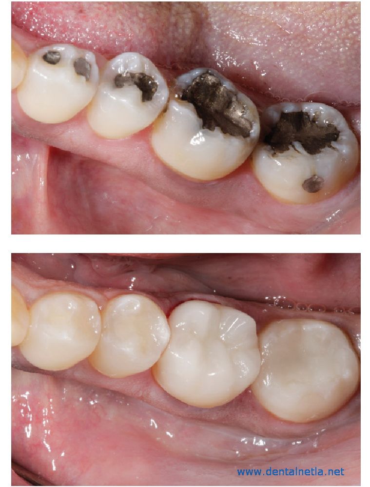 Before and after dental restoration result collage