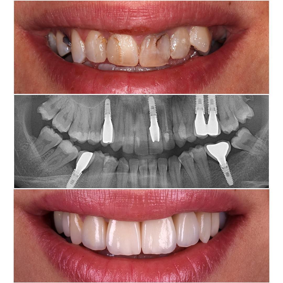 Before and after smile and implant treatment collage