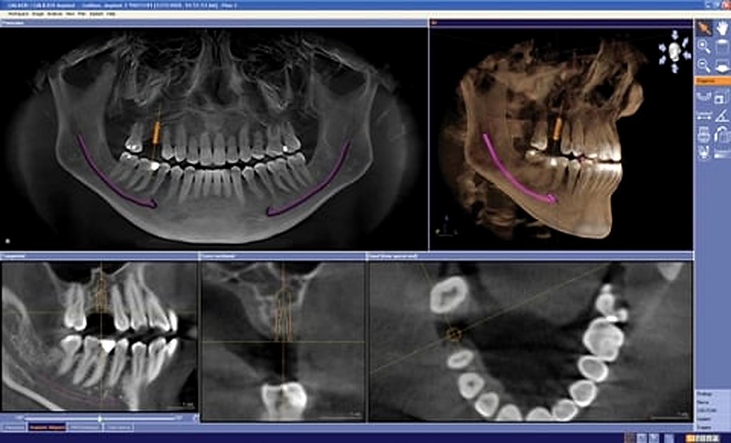 CBCT scan interface used for advanced dental diagnostics