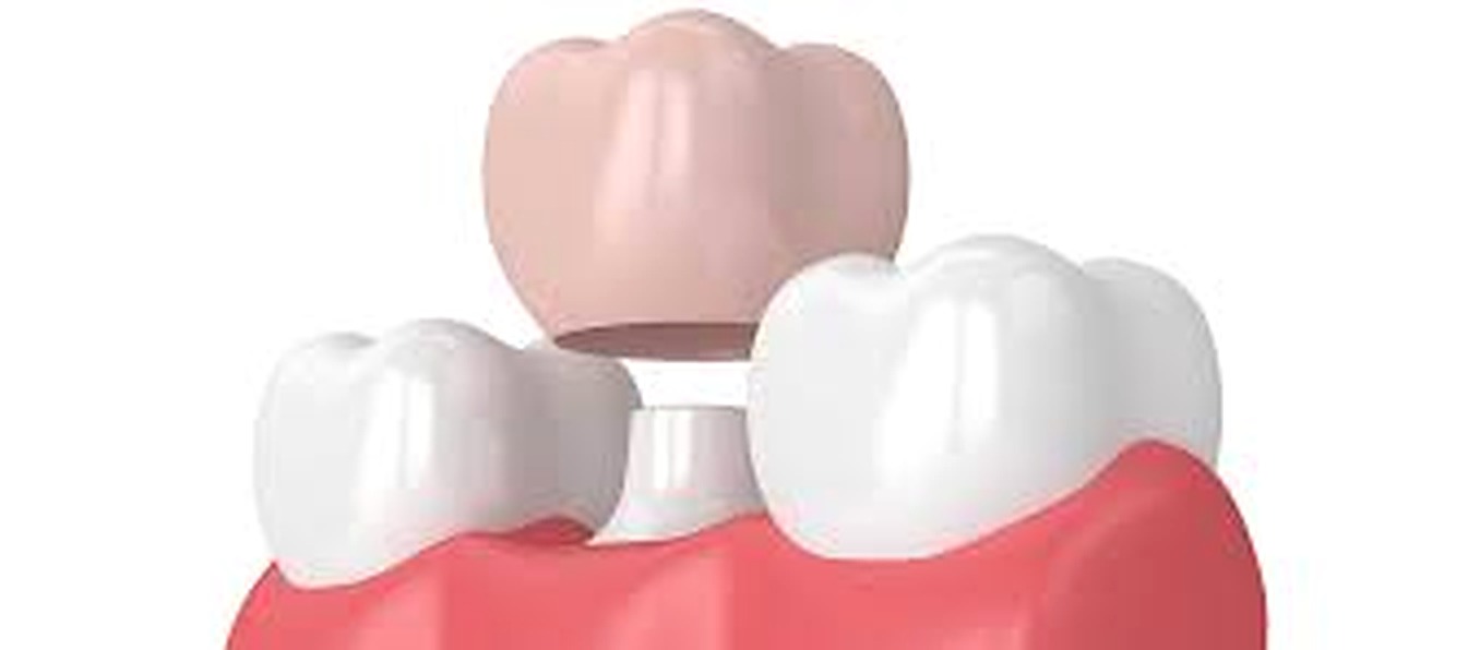 Same-day crown technology setup for faster restorative care