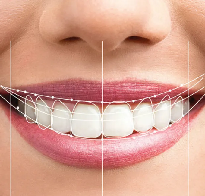 Smile makeover result showing a bright, confident smile