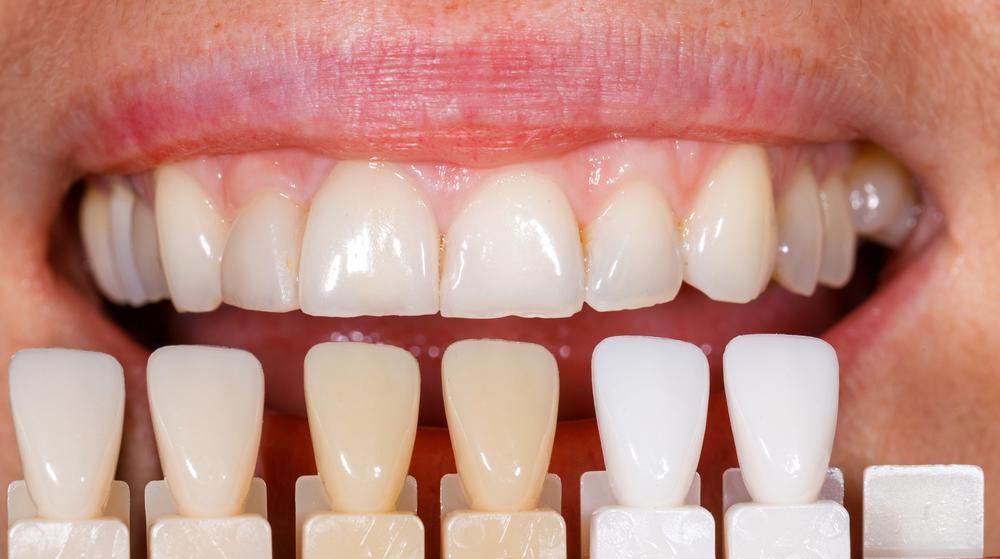 Veneer treatment visual showing refined front teeth